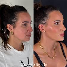 TGIF! This beauty is the perfect example of what can happen when a patient  trusts the process. She came in for a full-face consultation, and together  we created a plan that was