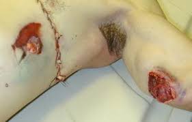 In the case of victims with gunshot wounds to the head, a forensic study of bullet holes and fractures in a skull can determine the trajectory of bullets through the cranium. Forensic Pathology Of Firearm Wounds Overview Modern Small Arms Epidemiology