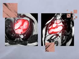 Image result for Cardiac MRI