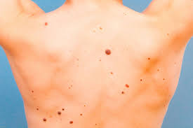 If breast cancer is diagnosed at an early enough stage, it's treatable. How To Tell If Moles Are Skin Cancer Teen Vogue