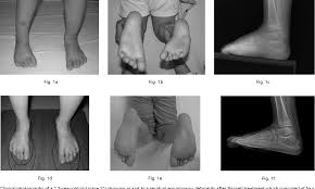 But the condition may be passed down through families in some cases. Pdf Selective Soft Tissue Release For Recurrent Or Residual Deformity After Conservative Treatment Of Idiopathic Clubfoot Semantic Scholar