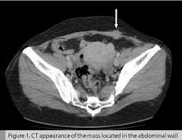 It was first described by villar in 1860. Figure 1 From A Case Of Abdominal Wall Endometriosis Mimicking Strangulated Incisional Hernia Semantic Scholar