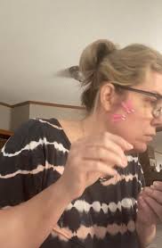 Has anyone had a brow or cheek thread lift and have healed pictures of it?