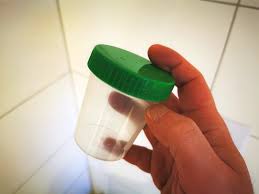 Zur früherkennung von prostatakrebs bei männern ab 50 jahren,   frühen stadium entdeckt wird und die mikroskopische untersuchung von gewebe einen. Prostata Untersuchung Schmerzen Ablauf Erfahrung Beim Urologen