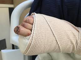 Image result for toe amputation