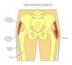 9 Best Exercises For Hip Bursitis Best Exercise For Hips Bursitis Hip Hip Workout