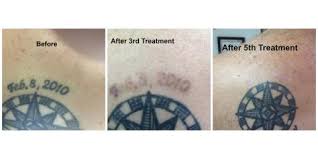 What tattoo removal really feels like. East Coast Laser Tattoo Removal A State Of The Art Procedure That S Comparatively Pain Free East Coast Laser Tattoo Removal Tuckahoe Nearsay
