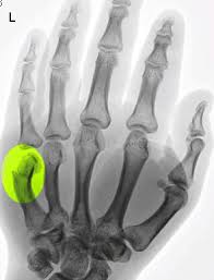 A boxer's fracture is the break of the 5th metacarpal bones of the hand near the knuckle. Figure Boxer Fracture Of Left Hand Image Courtesy S Bhimji Md Statpearls Ncbi Bookshelf