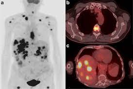 Pet scan is a special type of imaging test in which tracers are injected & are absorbed into organs of body and images are obtained. Fdg Pet Ct Provides Valuable Oesophageal Cancer Updates Physics World