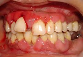 Download high resolution gingivitis stock photos from our collection of 41,940,205 stock photos. What Is Gingivitis Gingivitis Chat Online Periodontal Gum Disease Blog Dental Gingivitis Questions And Online Oral