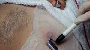 The term electrolysis branded the process of permanent hair removal. Electrolysis Around The Male Nipple Youtube
