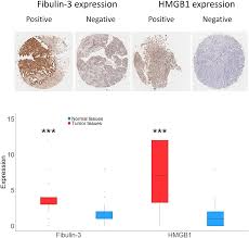 We did not find results for: Overexpression Of Fibulin 3 In Tumor Tissue Predicts Poor Survival Of Malignant Mesothelioma Patients From Hand Spinning Asbestos Exposed Area In Eastern China Scientific Reports