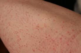 Ingrown hairs can crop up anywhere, from the legs to the bikini line and under arms to the jawline, so firstly, avoid the temptation to squeeze it, as you could end up pushing the hair deeper into the. 10 Tips To Prevent Ingrown Hair