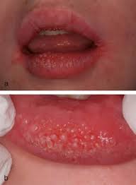 Oral Lymphangiectasias And Crohn S Disease Two Case Reports Oral Surgery Oral Medicine Oral Pathology And Oral Radiology