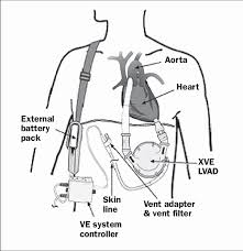 The Heartmate Xve Left Ventricular Assist Device Lvad The Inflow Download Scientific Diagram Marvel's guardians of the galaxy: the heartmate xve left ventricular