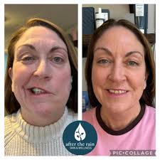 🌟Before & After: CACI Treatment for Bell's Palsy This transformation  speaks for itself. Using advanced microcurrent therapy, CACI treatments  help stimulate facial muscles, improve symmetry, and support nerve recovery  — without surgery