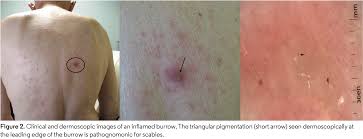 Image result for scabies on humans