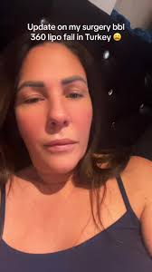 BBL Update: My Experience with 360 Liposuction Issues