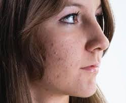 Maybe you would like to learn more about one of these? High Dose Isotretinoin Evaluated For Acne Treatment Relapse Mpr