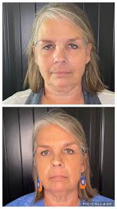 Dermal-Fillers-Baytown, Texas