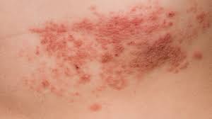 The bumps in both cases are red and usually burn or itch. Shingles Symptoms With Pictures