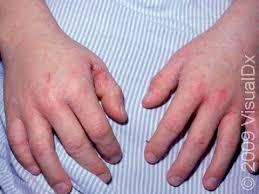 Image result for scabies symptoms