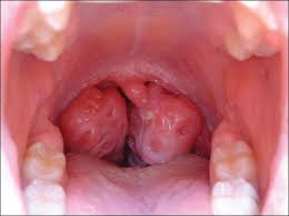 When that happens it's known as tonsillitis, which is a lot more common in children but adults can also get it. Post Tonsillectomy Complications More Likely In Children From Lower Income Families Ucla