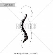 Symptoms of sciatica… sharp shooting pain in the back of the leg all the way to the underneath of the big toe. Spinal Deformity Flat Vector Photo Free Trial Bigstock
