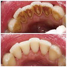 Cleaning & Dental Health Education | Dentist Dublin And Pleasanton Ca
