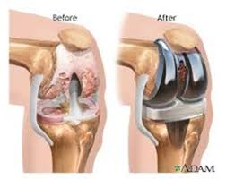 Beberapa penyebab kaki berbentuk o adalah : Tindakan Operasi Pada Osteoarthritis Rsudmangusada Badungkab Go Id