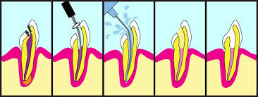 I chose to have total dental revision surgery in one 7 hour sedation session. Root Canal What To Expect Benefits Risks And Costs Ask The Dentist