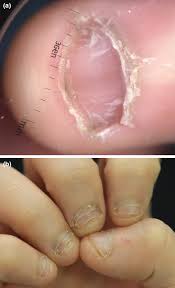 Image result for Onychotillomania feet