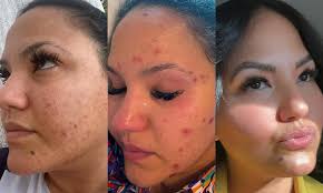 Impactante transformación del cutis de la influencer Beverly Vargas