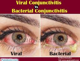 Jpmreloaded What To Do When You Have Pink Eye Conjunctiviti Natural Pink Eye Remedy Pink Eye Treatment Pinkeye Remedies