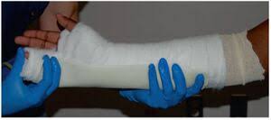 Image result for Ulnar Gutter Cast