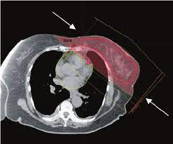 A Axial View Of A Ct Based Breast Radiation Treatment Plan Two Download Scientific Diagram
