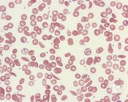 Sickle cell disease (anemia) symptoms, genetics, diagnosis, treatment, and life expectancy. Sickle Cell Disease Rbc Morphology 1