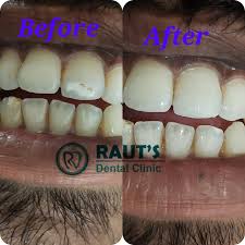 Raut S Dental Clinic Enamel Hypoplasia Is A Defect Of The Enamel That Only Occurs While Teeth Are Developing Affects Both Primary Baby And Permanent Teeth This Conditions Results