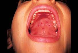 Symptoms of mononucleosis include a sore throat, enlarged tonsils, laryngitis, swollen lymph nodes in the neck or armpits, fever, head and body aches. Infectious Mononucleosis Picture Image On Medicinenet Com