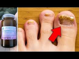 как сделать мазь от грибка ногтей из яйца и уксуса Pin Na Doske A Saude