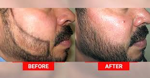 Houston hair transplant center employs a revolutionary technique called follicular unit extraction (fue). With Solution To Baldness This Thiruvalla Hospital Is A Success Story Lifestyle Beauty English