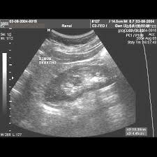 El ultrasonido de la pelvis utiliza ondas sonoras para producir imágenes de las estructuras y órganos de la parte inferior del abdomen y la pelvis. Ultrasonido Renal Ciem