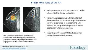 Inflammatory breast cancer usually does not produce a lump you can feel. Breast Mri State Of The Art Radiology