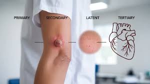 Image result for Tertiary Syphilis