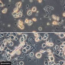 Abundant Tubular Epithelial Cells In A Patient With Aki Phase Contrast Original Magnificationx400 U Medical Laboratory Scientist Medical Laboratory Tubular