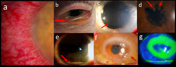 Image result for Ciliary Flush