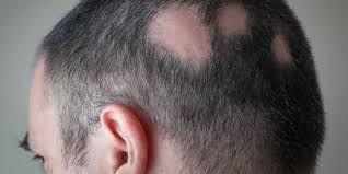 In its worst form, alopecia universalis causes you to lose all body hair. Losing Hair In Strange Places It Could Be Alopecia Areata