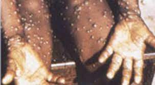 In this centers for disease control and prevention handout graphic, symptoms of one of the first known cases of the monkeypox virus are shown on a. K5uiuobvptktrm