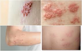 Acest virus este unul herpetic si va ramane in organism. Ce Trebuie Sa Stii Despre Zona Zoster O Afectiune Cu Riscuri Pe Termen Lung