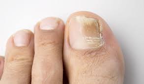Image result for onychomycosis